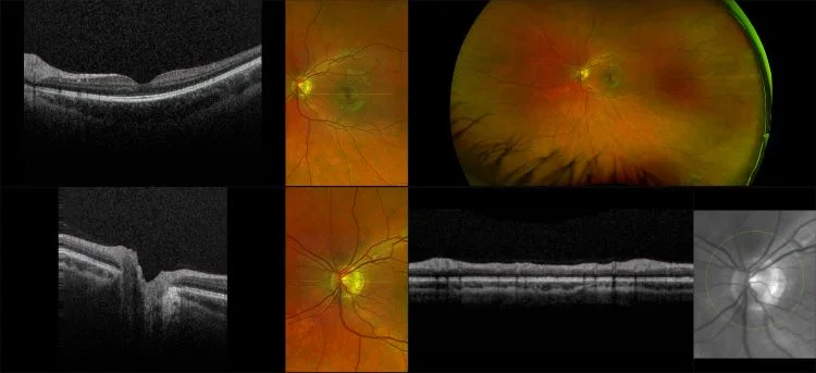 MonacoPro - Glaucoma, RG, OCT