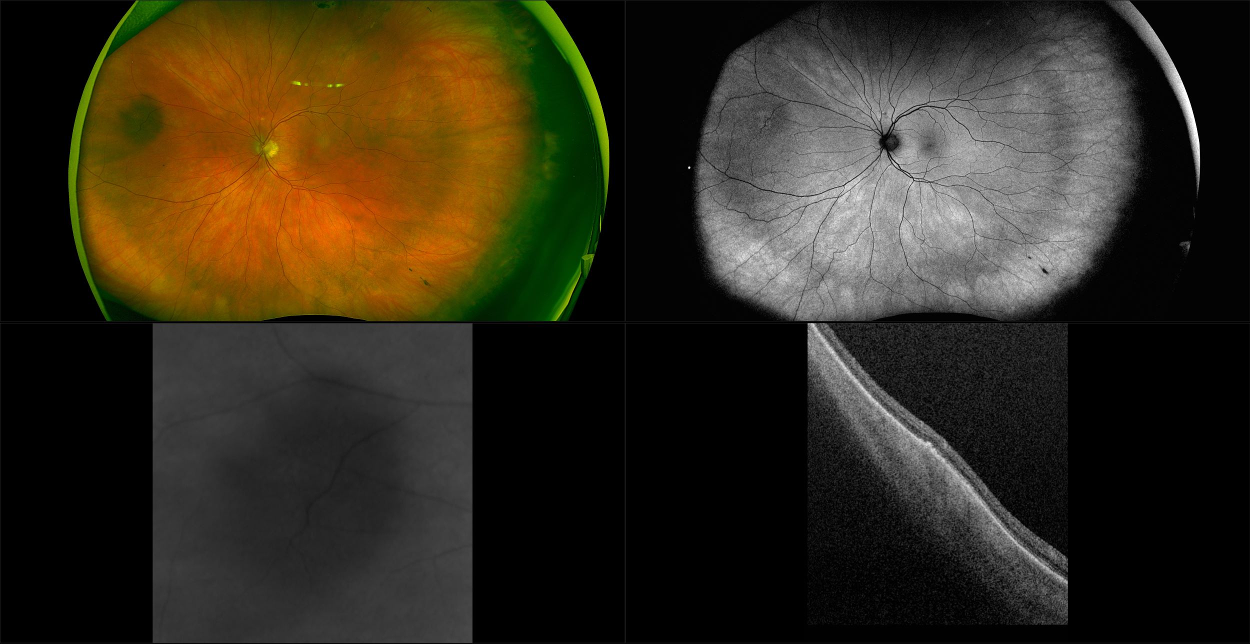 Silverstone - Peripheral Choroidal Nevus, RG, AF, OCT