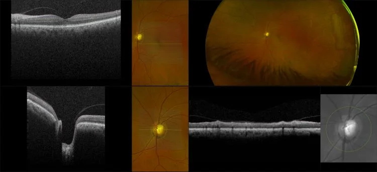 MonacoPro - Glaucoma with Deep Cup and Macular Pucker, RG, OCT