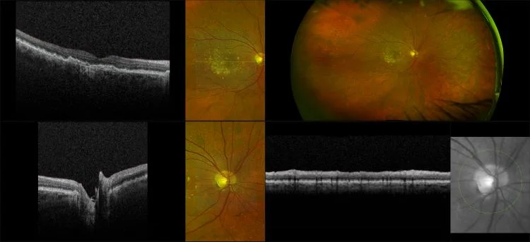 MonacoPro - Wet AMD with Macular Drusen and Sub-Retinal Fluid, RG, OCT