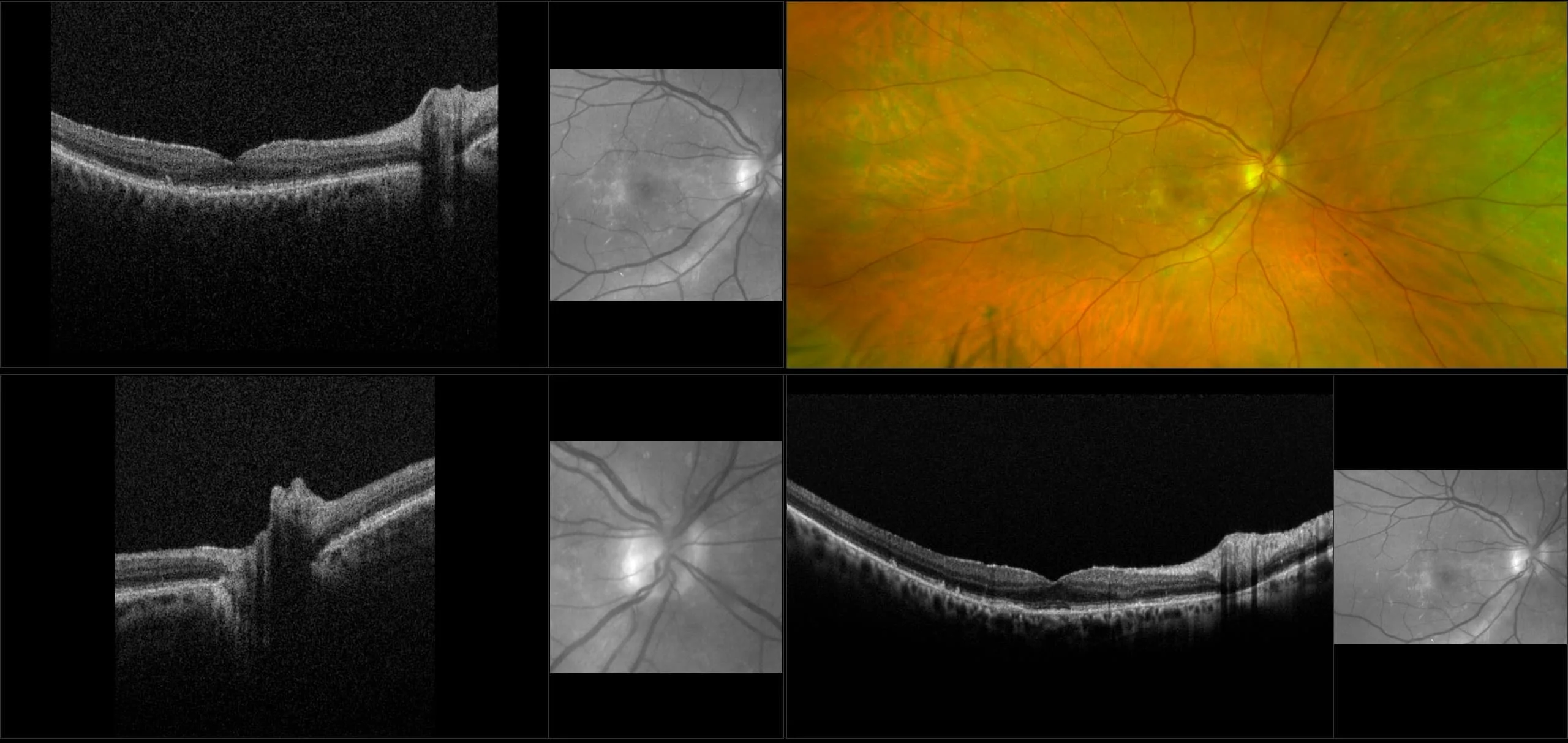 MonacoPro - Wet AMD with Drusen and PVD, RG, OCT