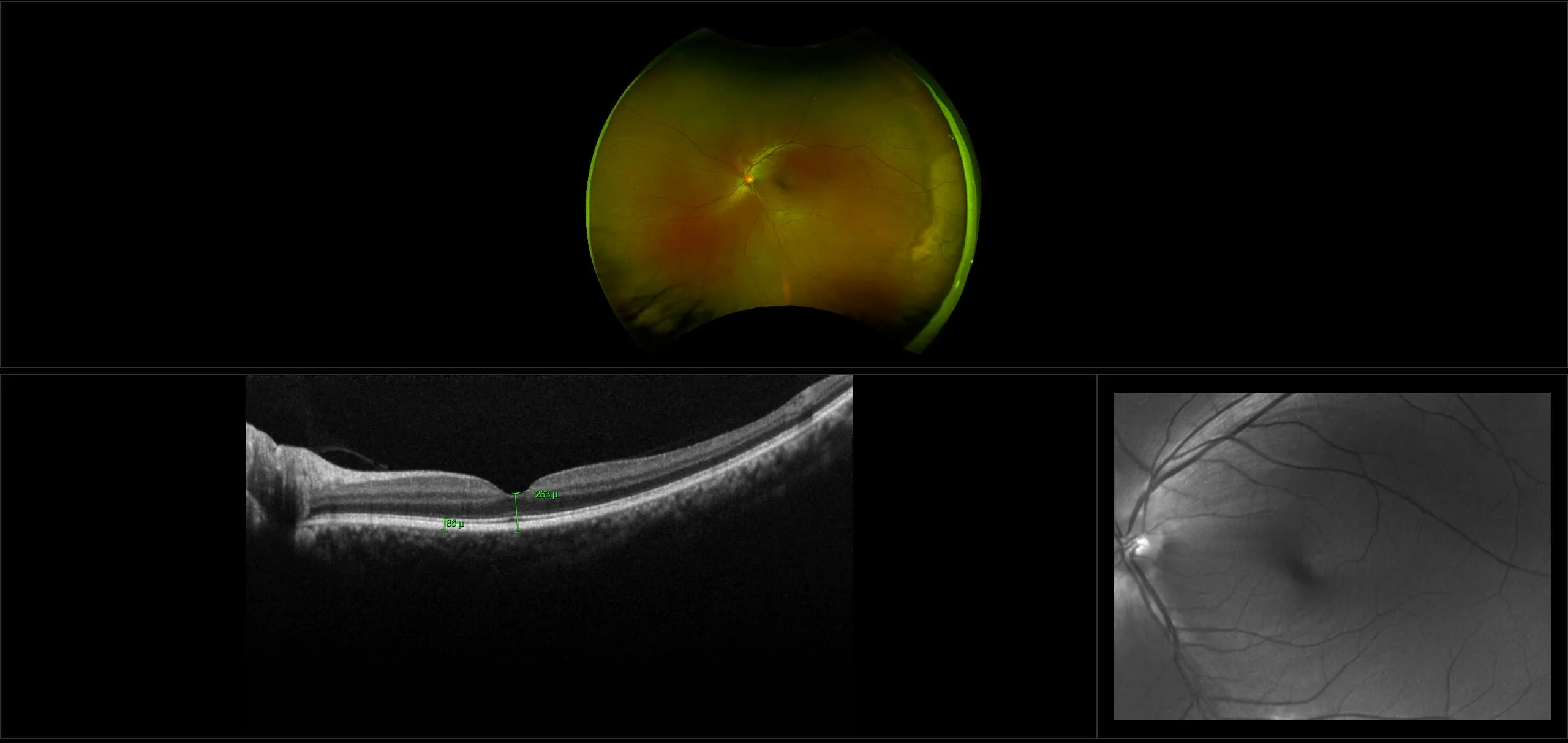 MonacoPro - Lattice Degeneration with White Without Pressure, RG, OCT