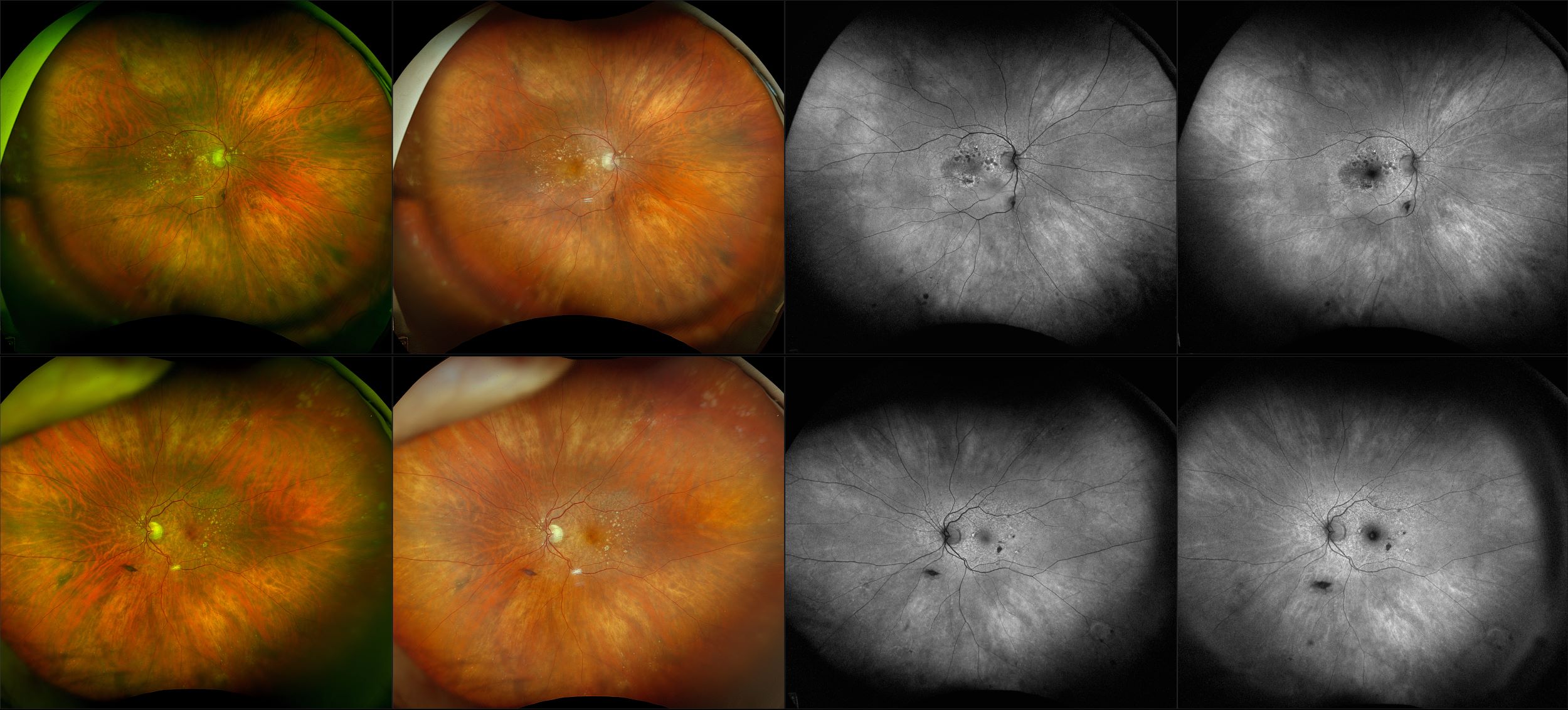 California - Geographic Atrophy, RG, RGB, AF, BAF