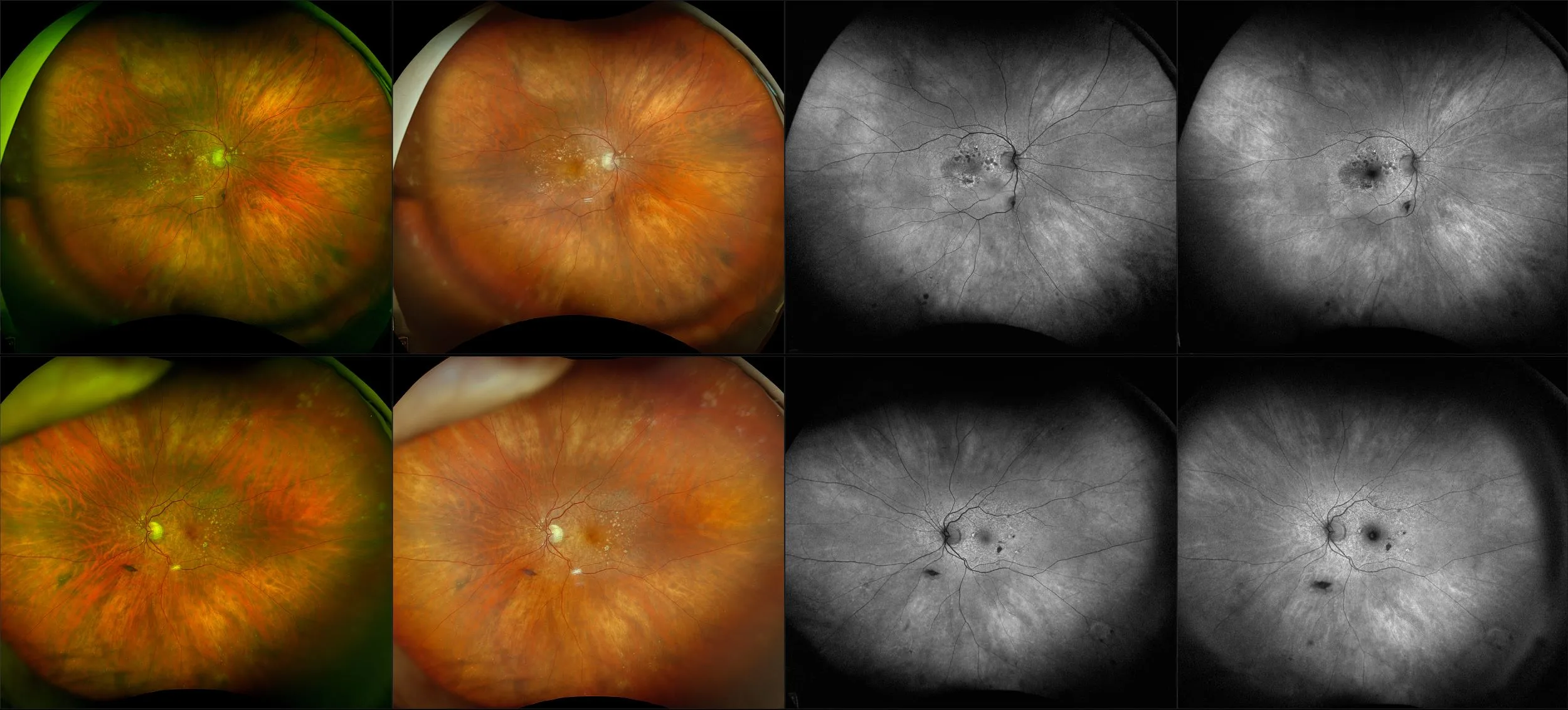 California - Nonexudative Age-Related Macular Degeneration with Geographic Atrophy, RG, RGB, AF, BAF