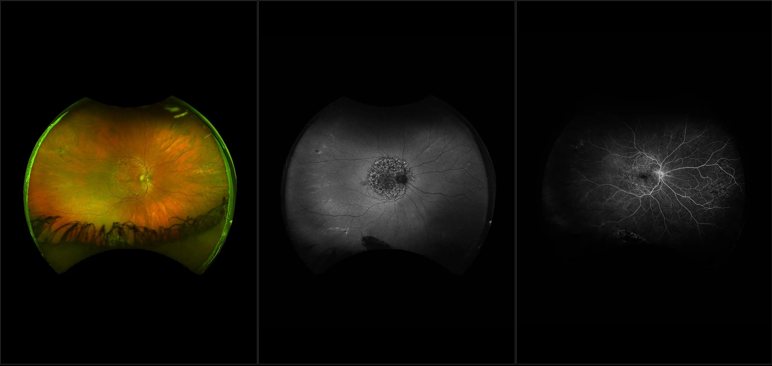 California - Stargardt's Disease, RG, AF, FA