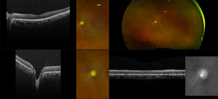 Monaco - Advanced  Glaucoma, RG, OCT