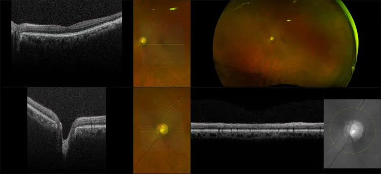 MonacoPro - Advanced  Glaucoma, RG, OCT