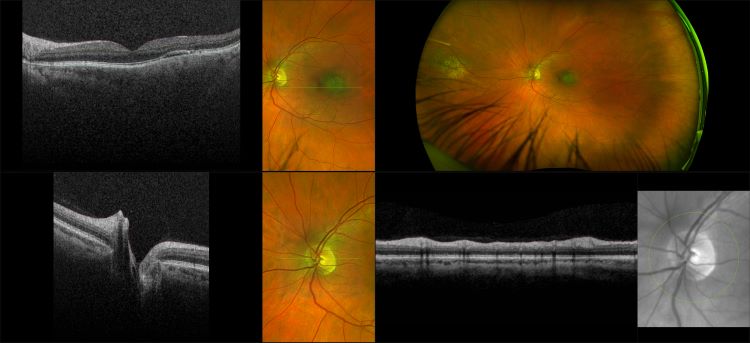 Monaco - Pigment Epithelial Detachment, RG, OCT