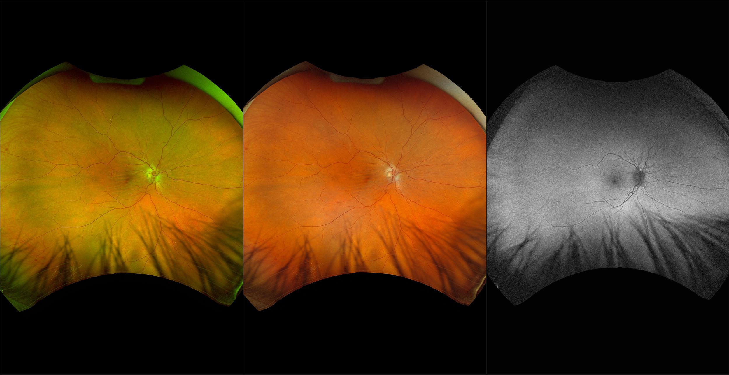 California - Idiopathic Choroidal Folds, RG, RGB, BAF