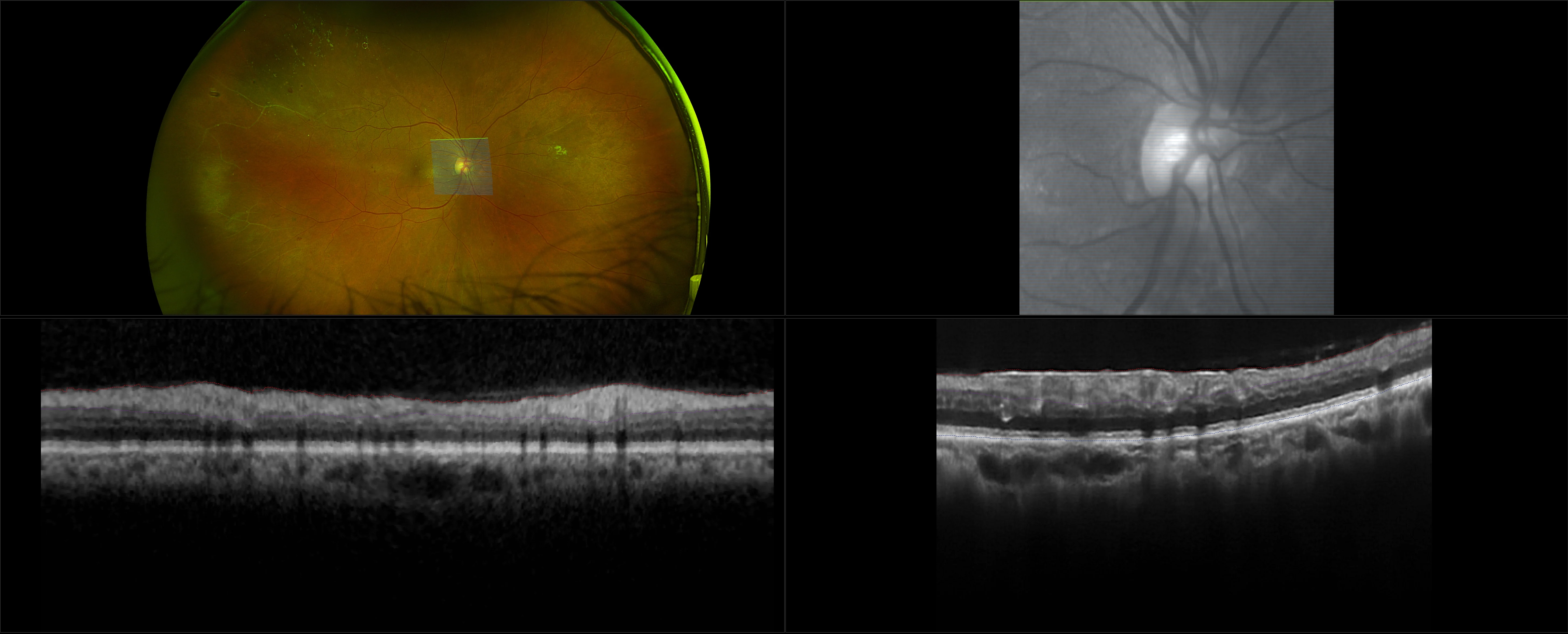 MonacoPro - Diabetic Retinopathy, DME, NVE - RG, OCT