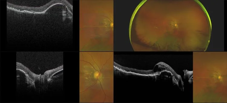 MonacoPro - Pigment Epithelial Detachment, RG, OCT