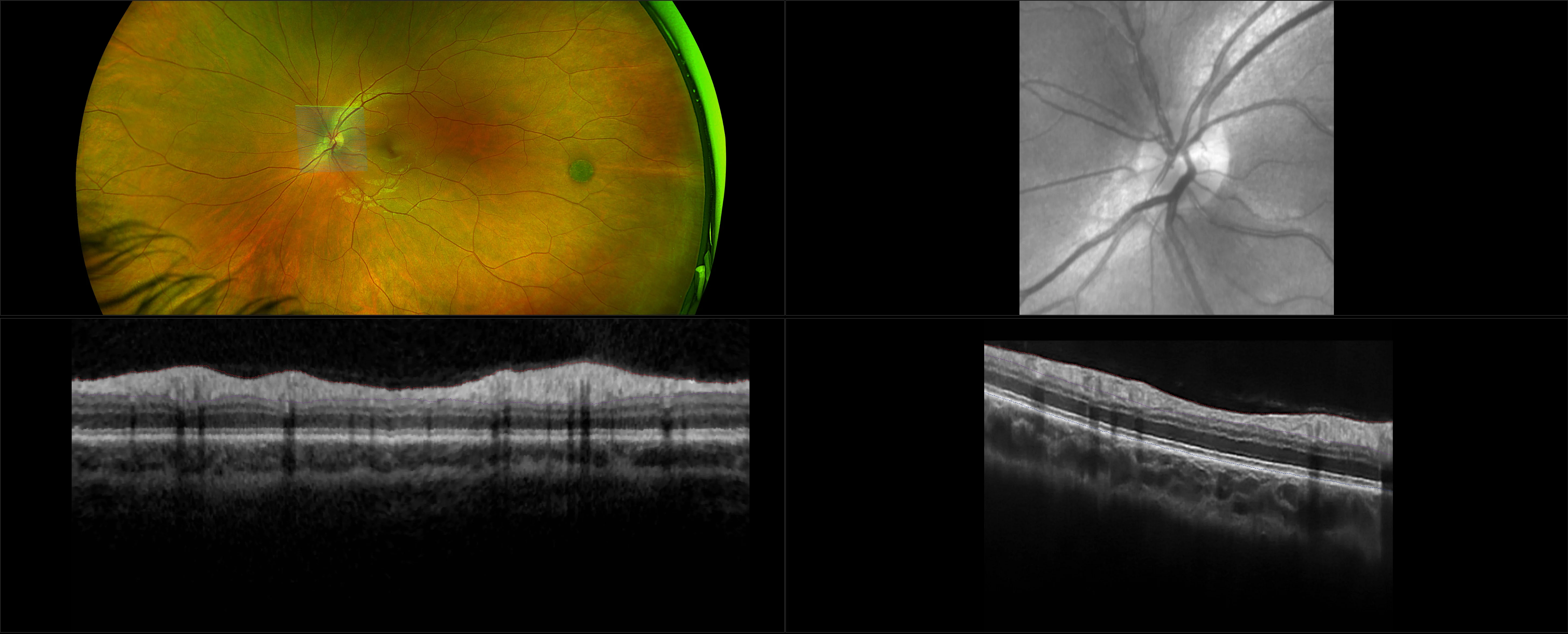 MonacoPro - Peripheral Pigmented Lesion - RG, OCT