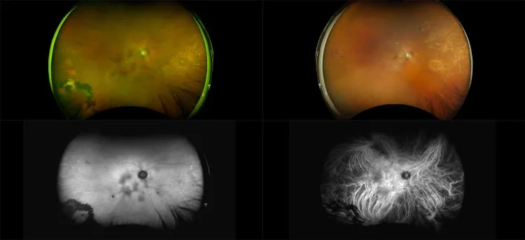California - Exudative Age-Related Macular Degeneration, RG, RGB, AF, ICG