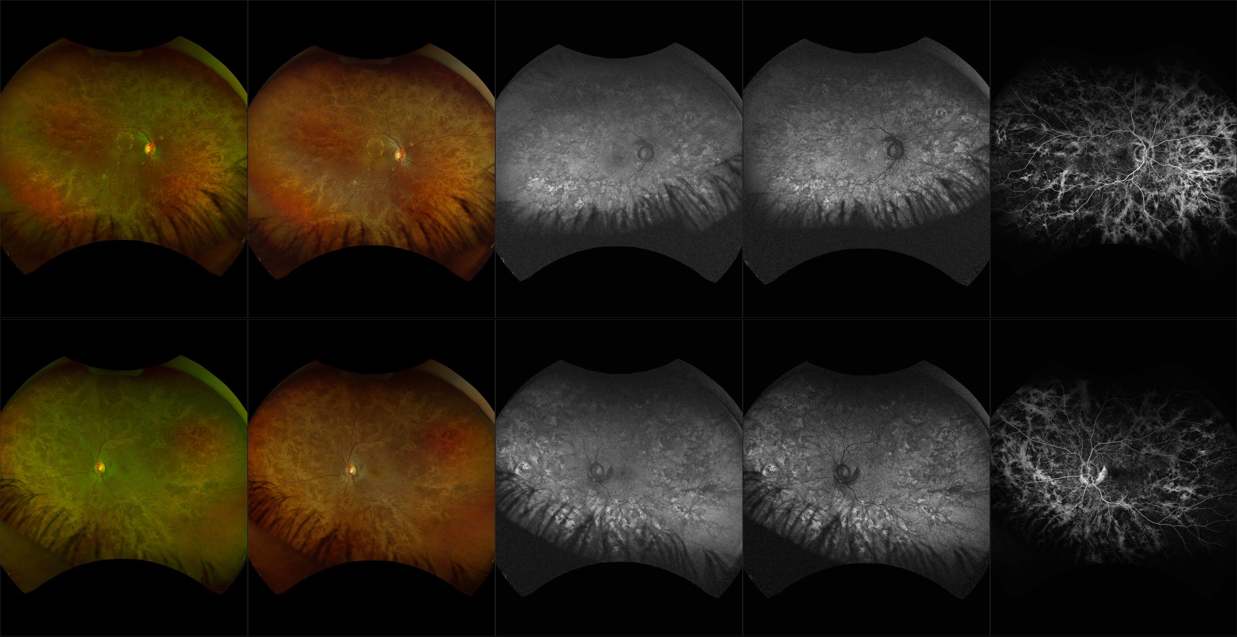 California - Atypical Scarring with Possible Inherited Retinal Disease, RG, RGB, AF, BAF, FA