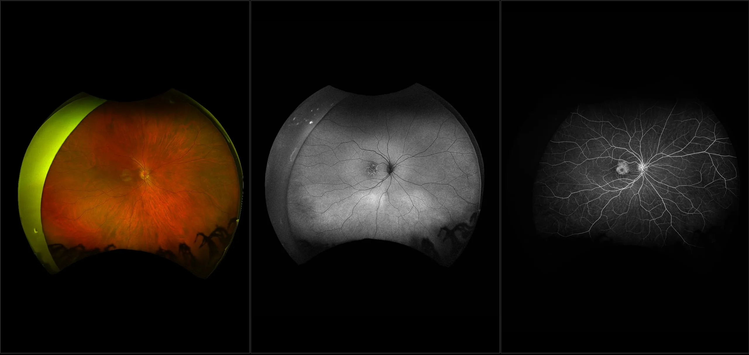 California - Cone-Rod Dystrophy (OU) - RG, AF, FA