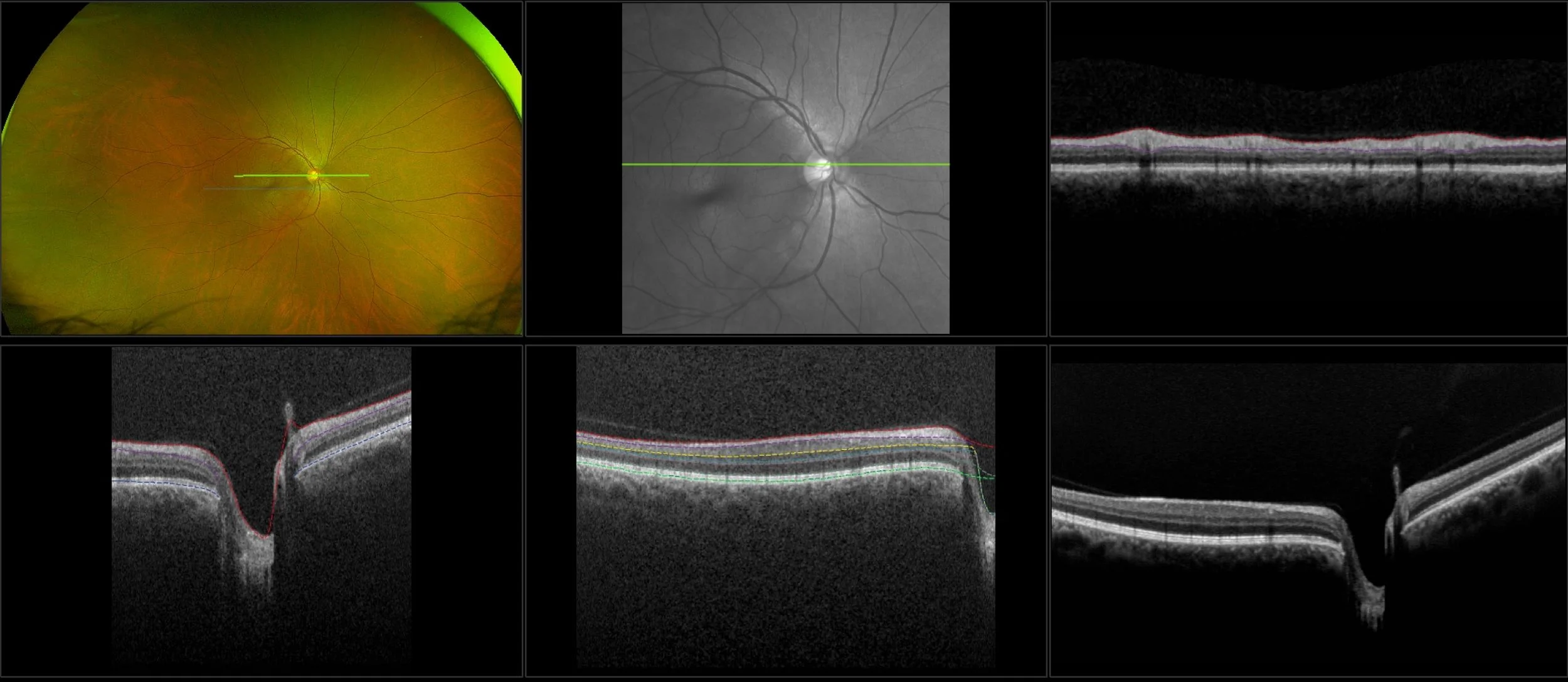 MonacoPro - Glaucoma, RG, Stereo, OCT