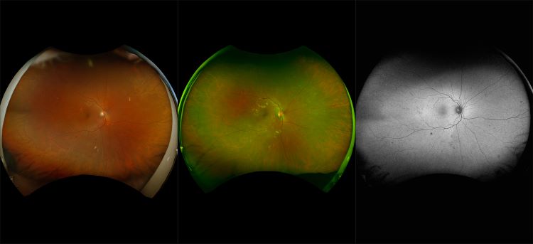 California - Proliferative Diabetic Retinopathy, RG, RGB, AF