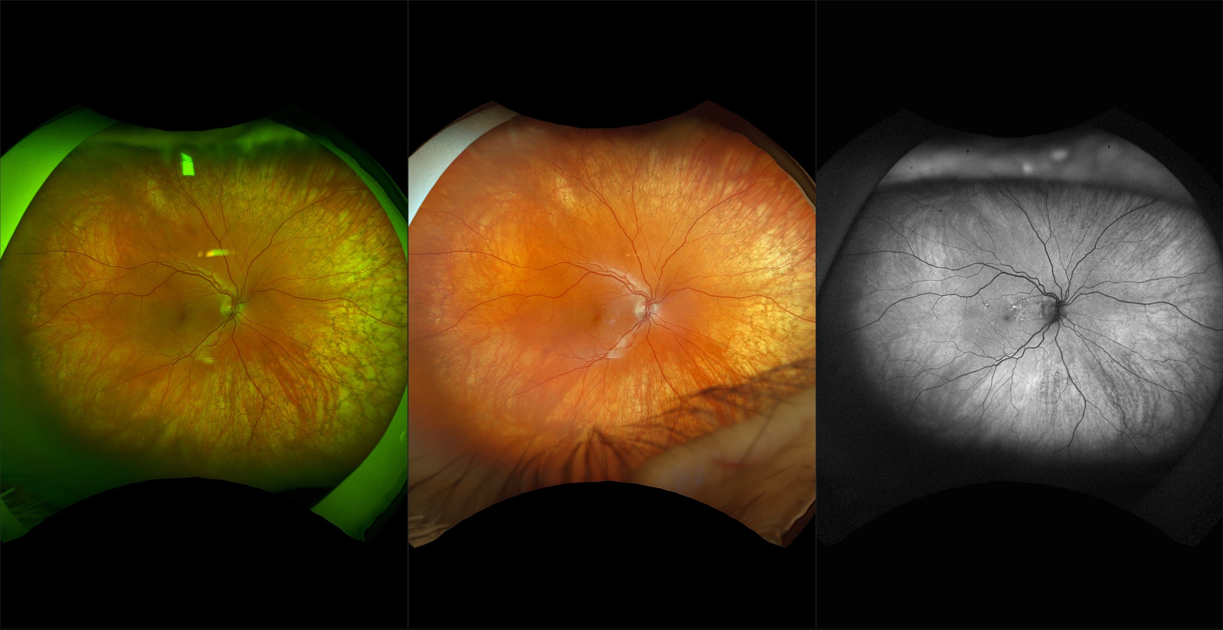 California - BRVO with Macular Edema, RG, RGB, AF