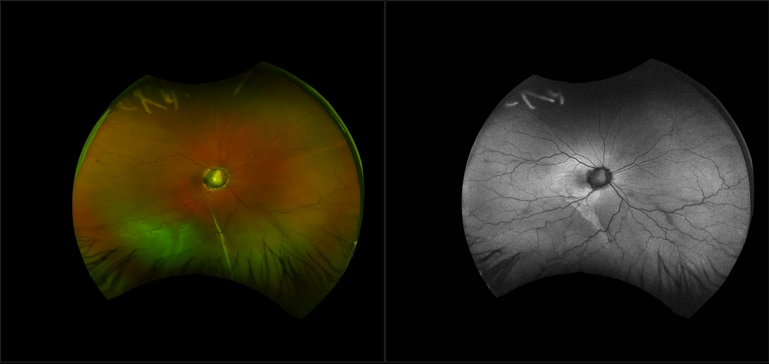 California - Morning Glory Disc Anomaly with Retinal Detachment - RG, AF