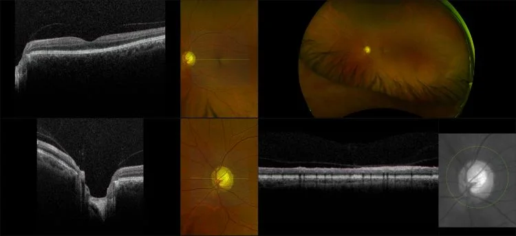 MonacoPro - Glaucoma with Superior Field Defect, RG, OCT