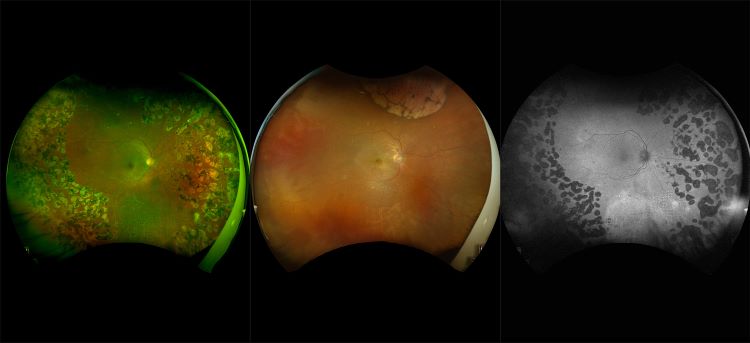 California - Treated Diabetic Retinopathy, RG, RGB, AF