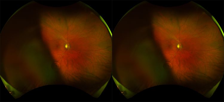 Daytona - Healthy Retina - Stereo - RG