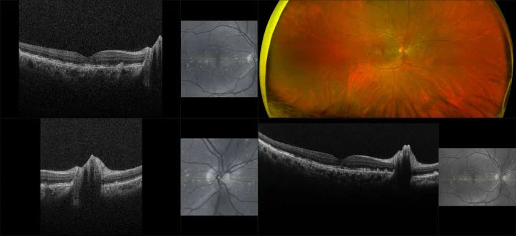MonacoPro - Dry AMD, RG, OCT