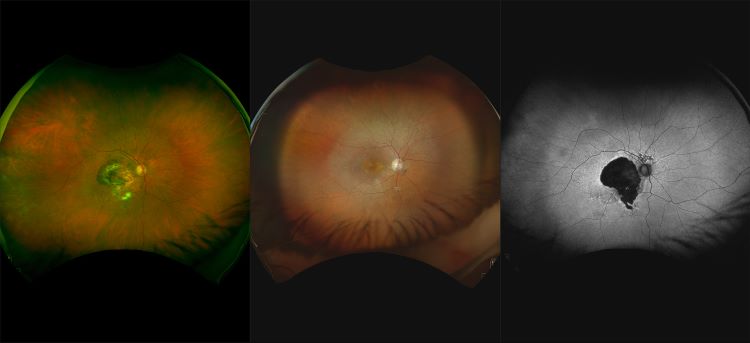 California - Choroidal Neovascular Membrane, RG, RGB, AF