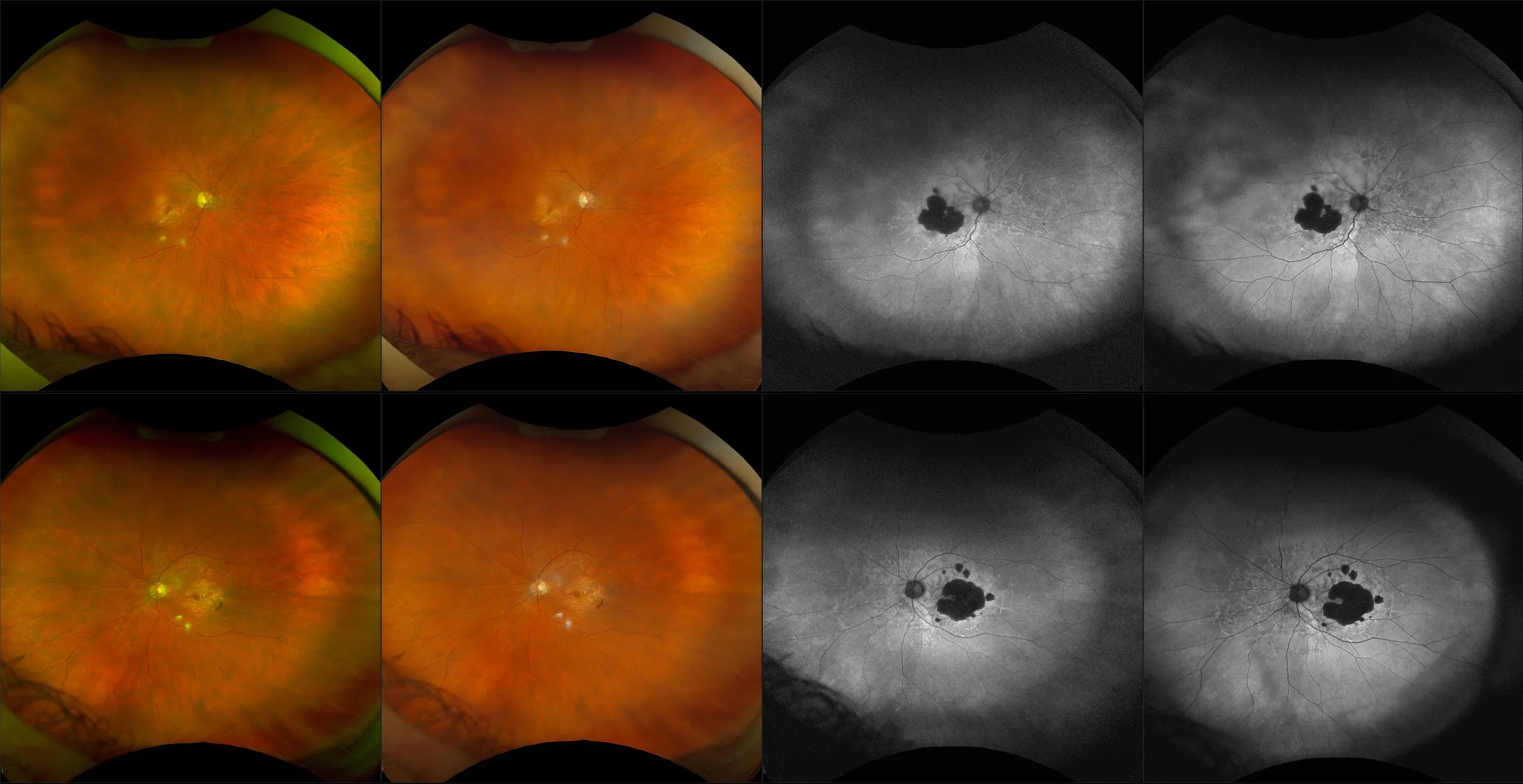 California - Nonexudative Age-Related Macular Degeneration with Geographic Atrophy, RG, RGB, AF, BAF