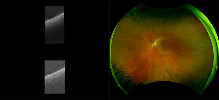 Silverstone - Far Peripheral Crystalline Deposits, RG, OCT