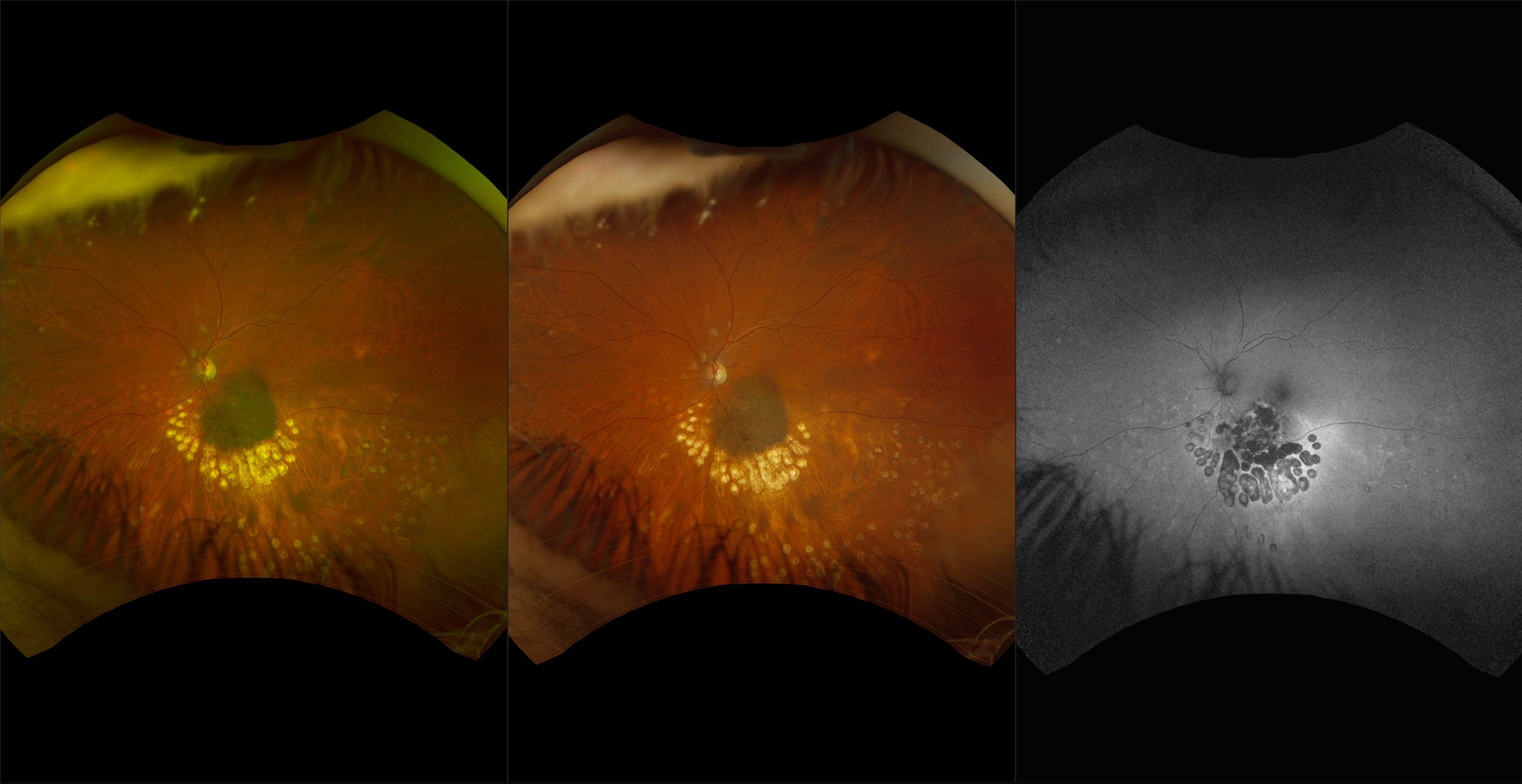 California - Radiated Uveal Malignant Melanoma with Post-Plaque Scatter Laser for Radiation Retinopathy, RG, RGB, BAF