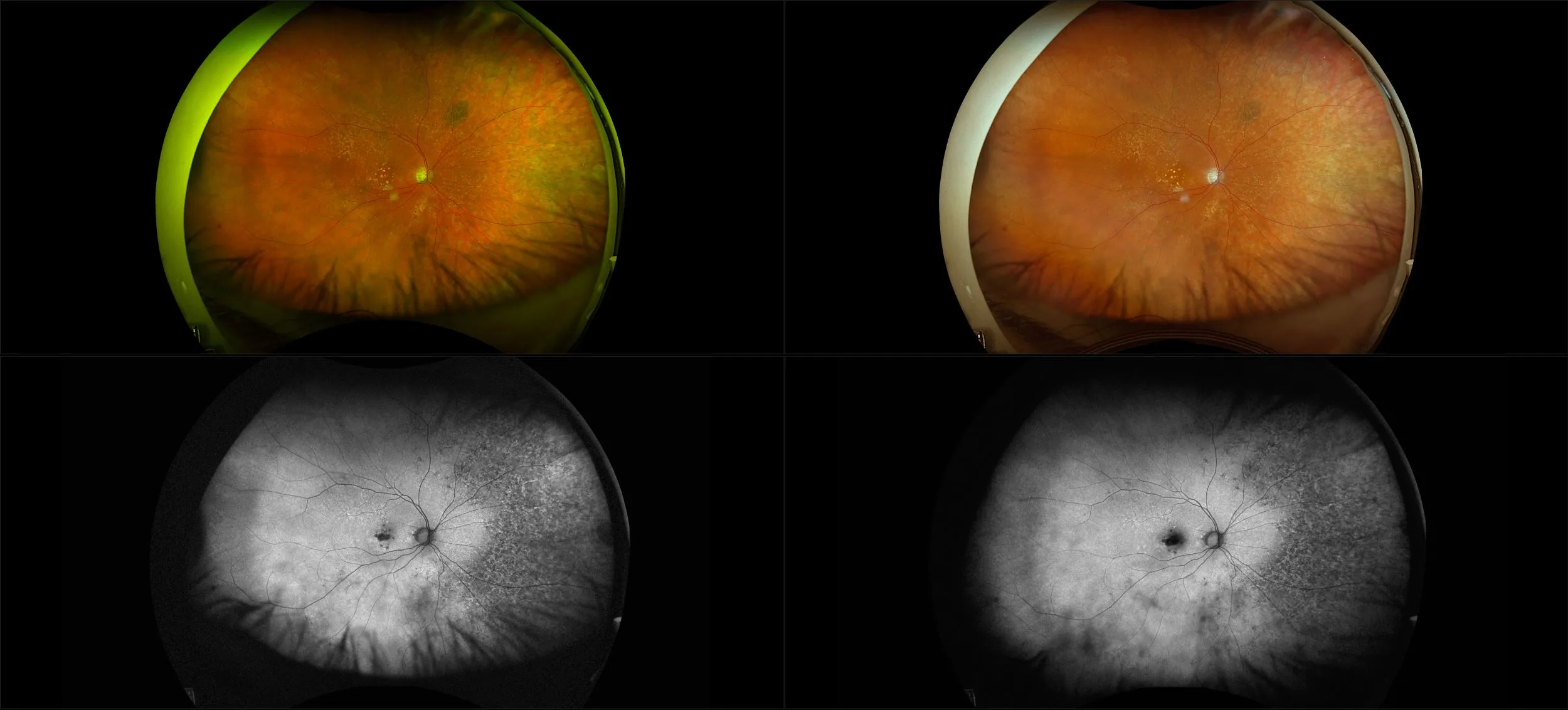 California - Nonexudative Age-Related Macular Degeneration with Geographic Atrophy, RG, RGB, AF, BAF