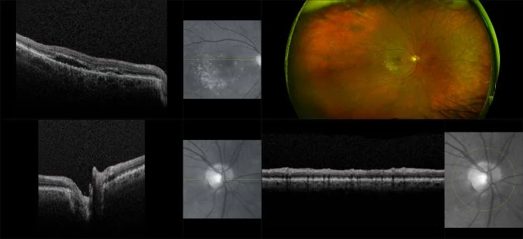 MonacoPro - Wet AMD with Macular Drusen and Sub-Retinal Fluid, RG, OCT