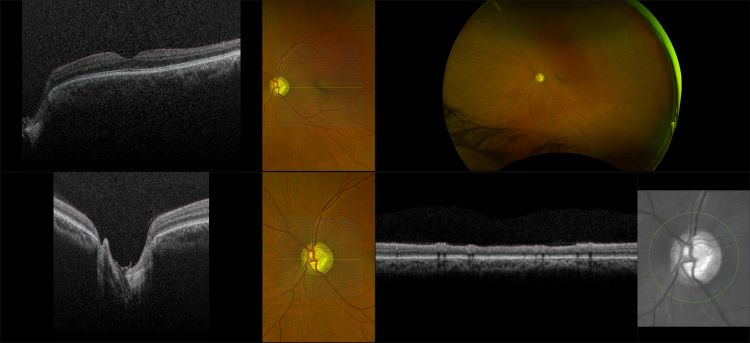 Monaco - Glaucoma, RG, OCT