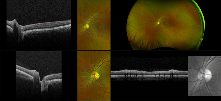 Monaco - Central Serous Retinopathy, RG, OCT