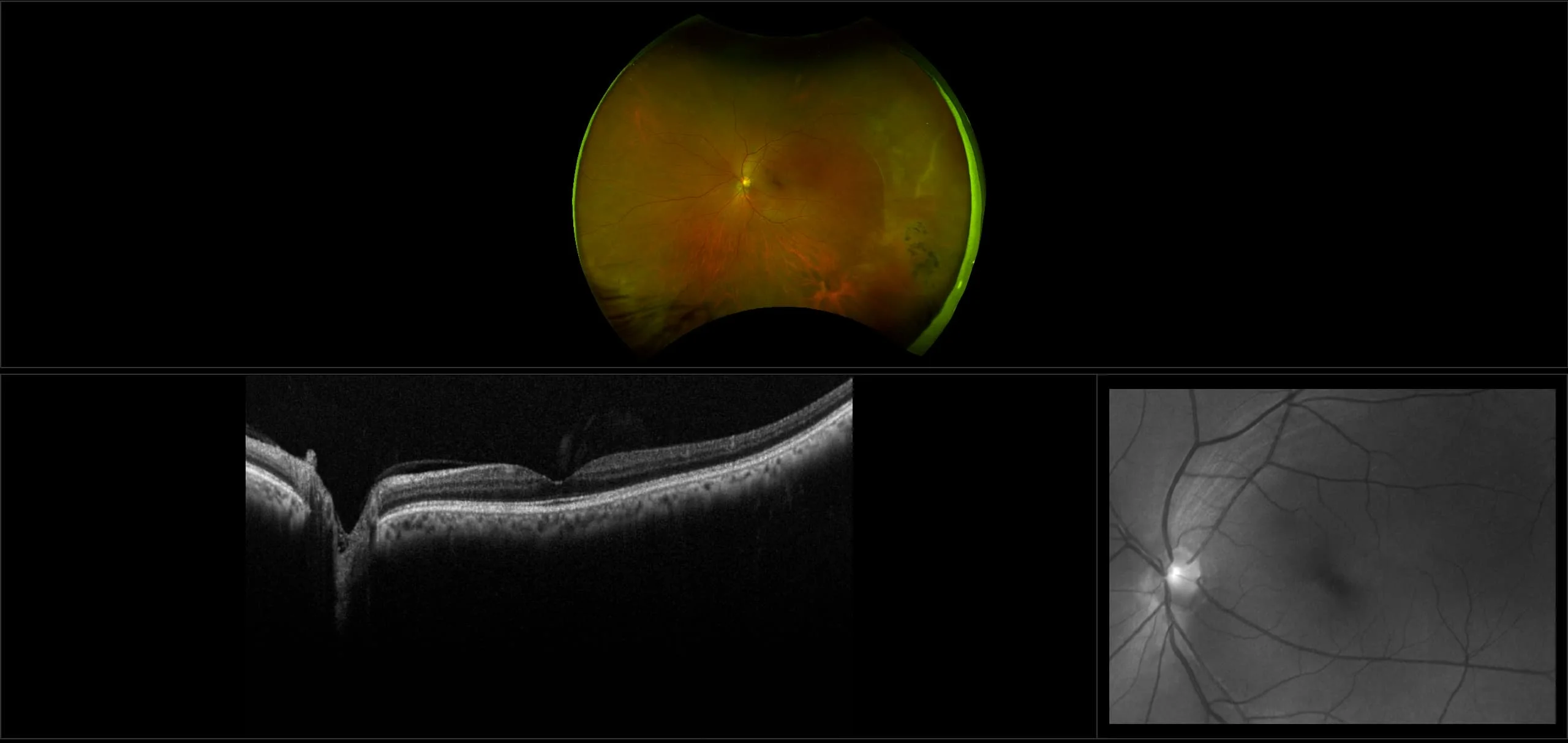 MonacoPro - Retinal Pigment Epithelium Hyperplasia with White without Pressure (WWOP), RG, OCT