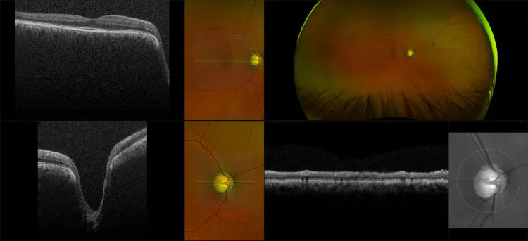 MonacoPro - Advanced  Glaucoma, RG, OCT