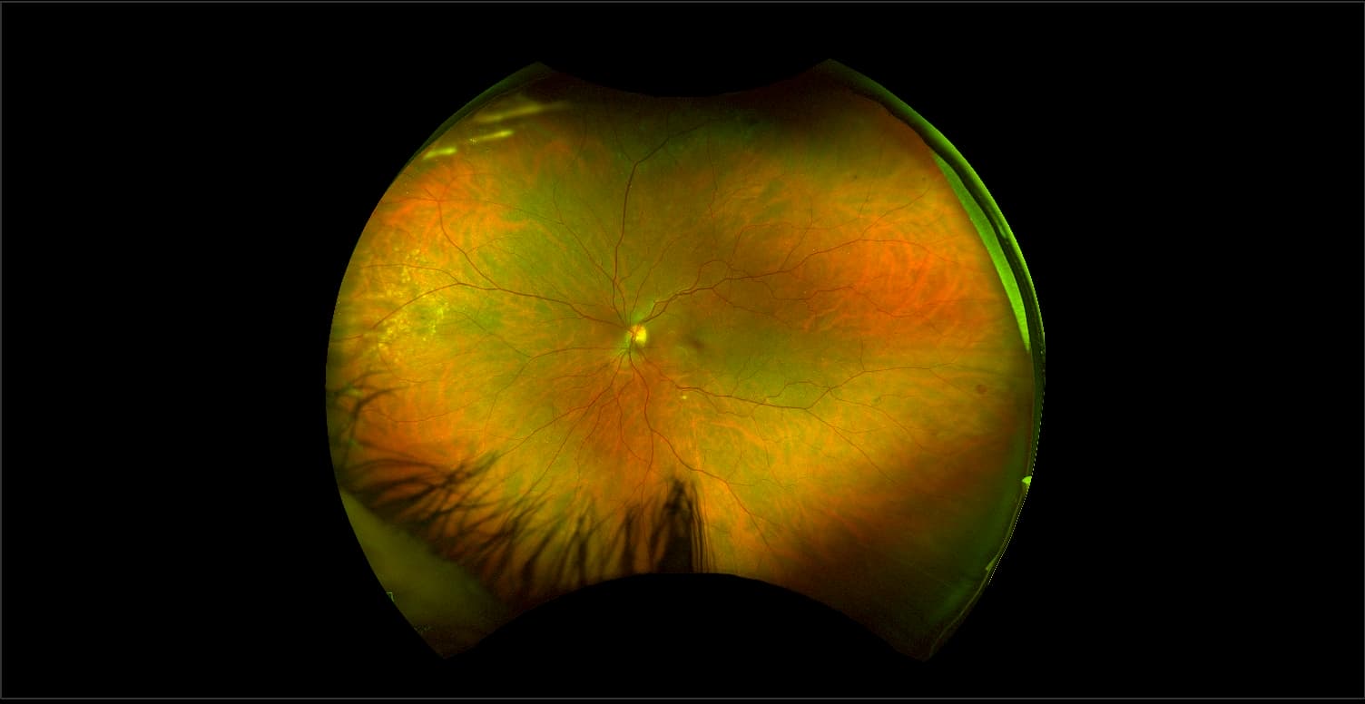 California - Hyperviscosity Retinopathy from Myeloma, RG