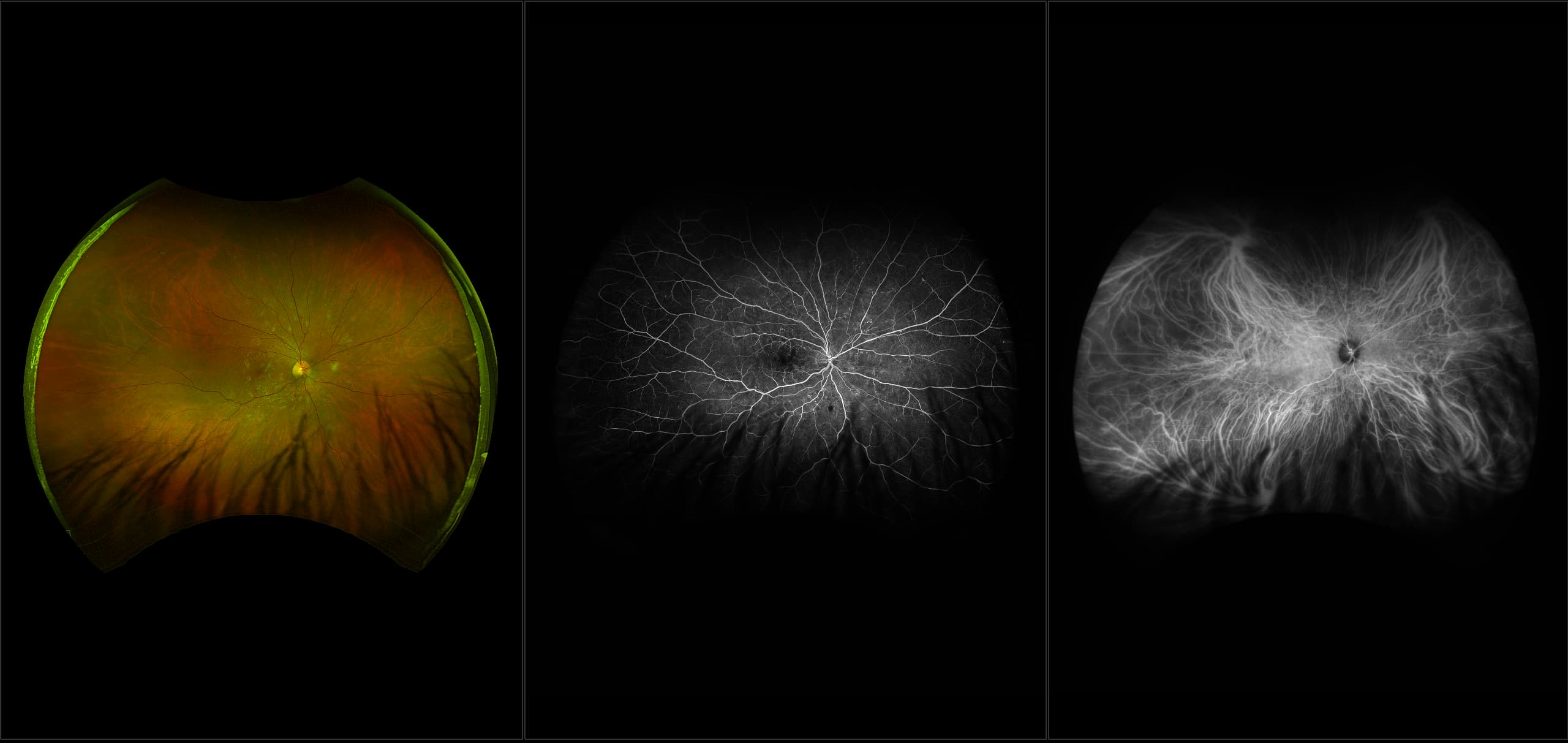 California - Purtscher's-like Retinopathy, RG, FA, ICG