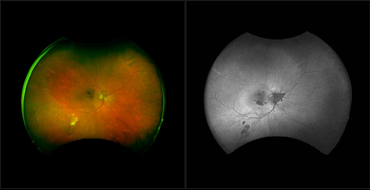 California - AMD with Geographic Atrophy, RG, AF