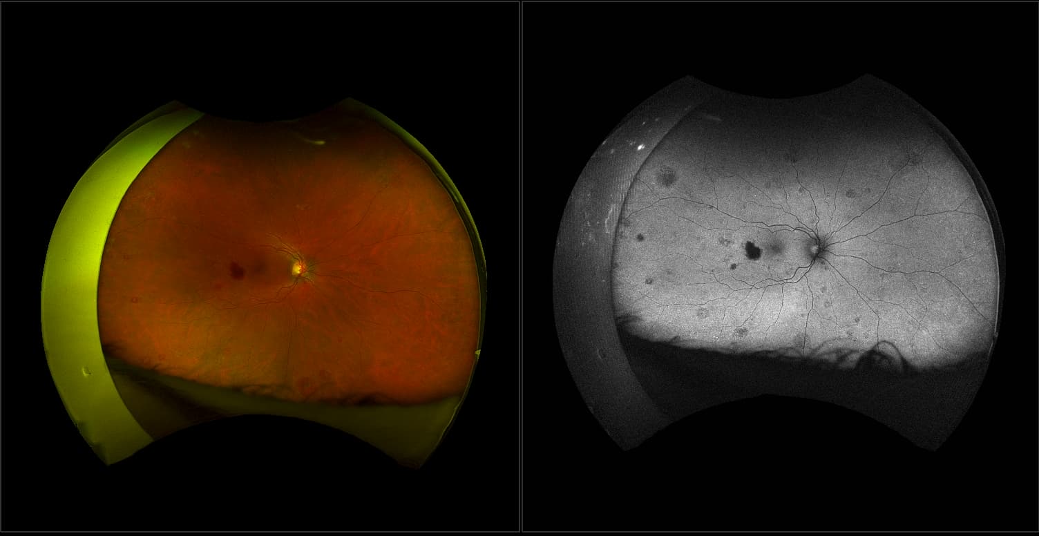 California - Leukemia with Retinal Heme, RG, AF