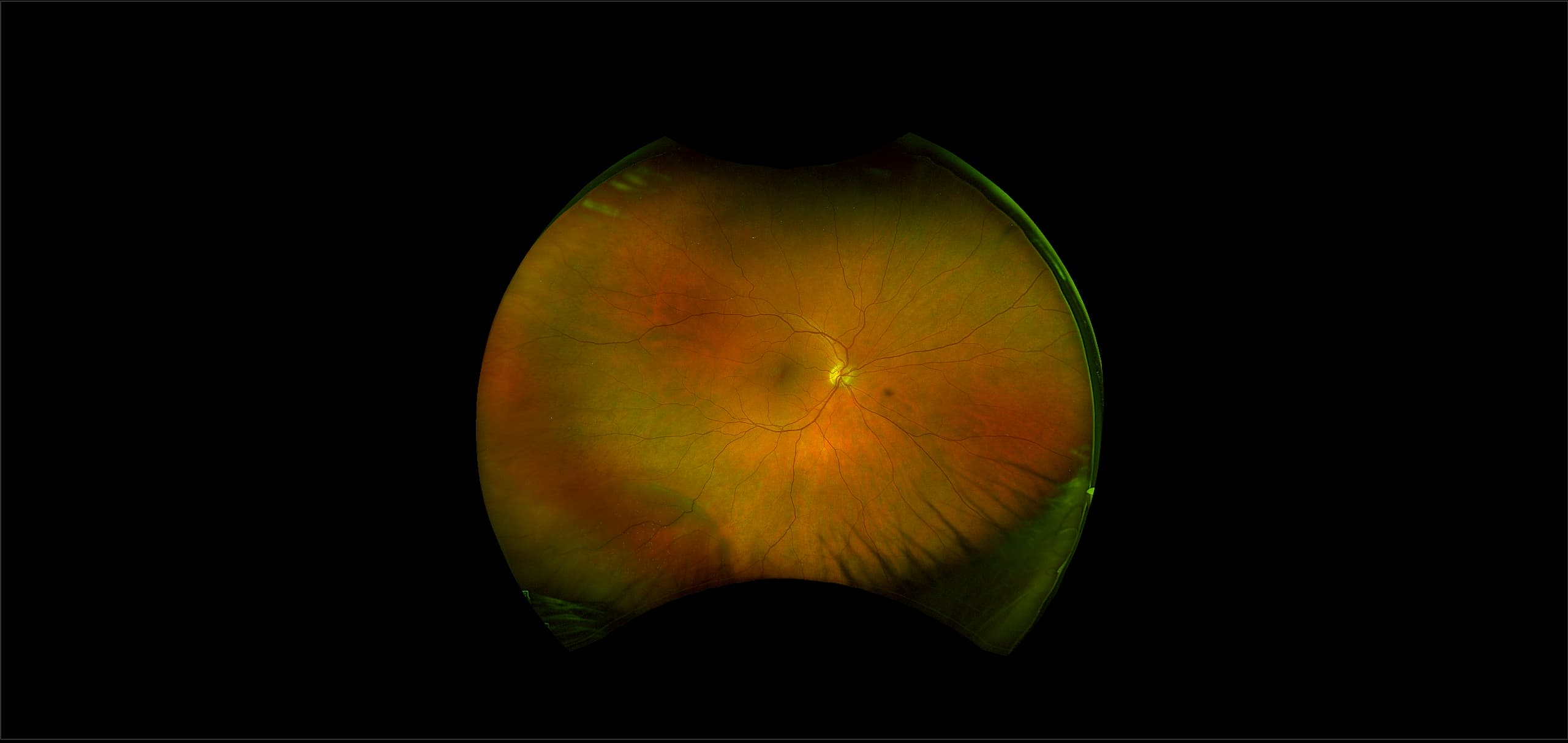 California - Retinoschisis, RG