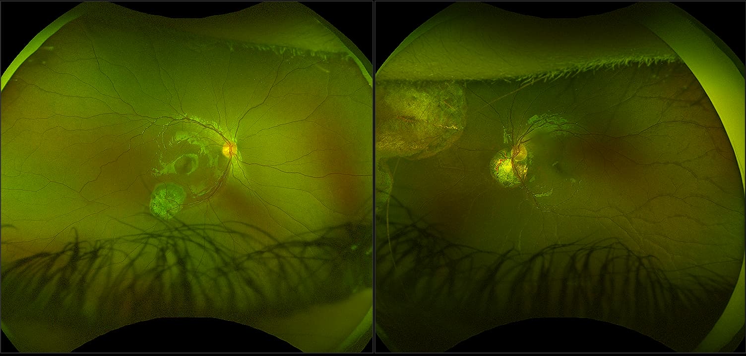 California - Retinoblastoma, Pediatric, RG