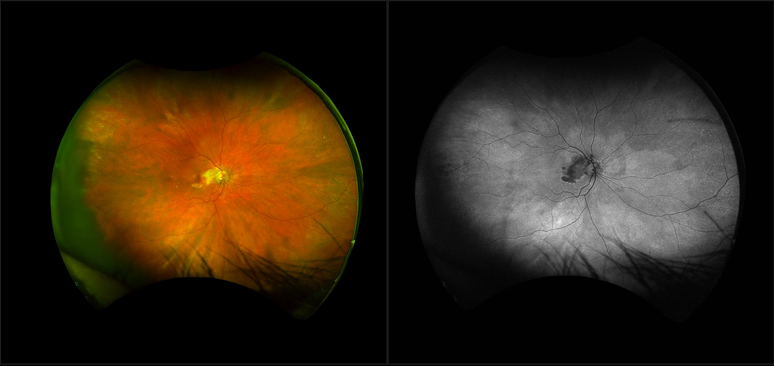 California - Osteoma with AMD and CNV, RG, AF