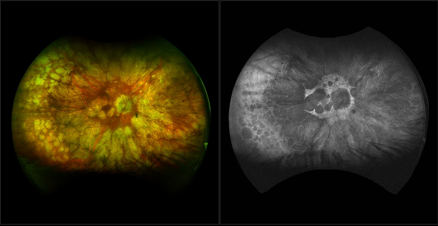 California - Gyrate Atrophy, RG, AF