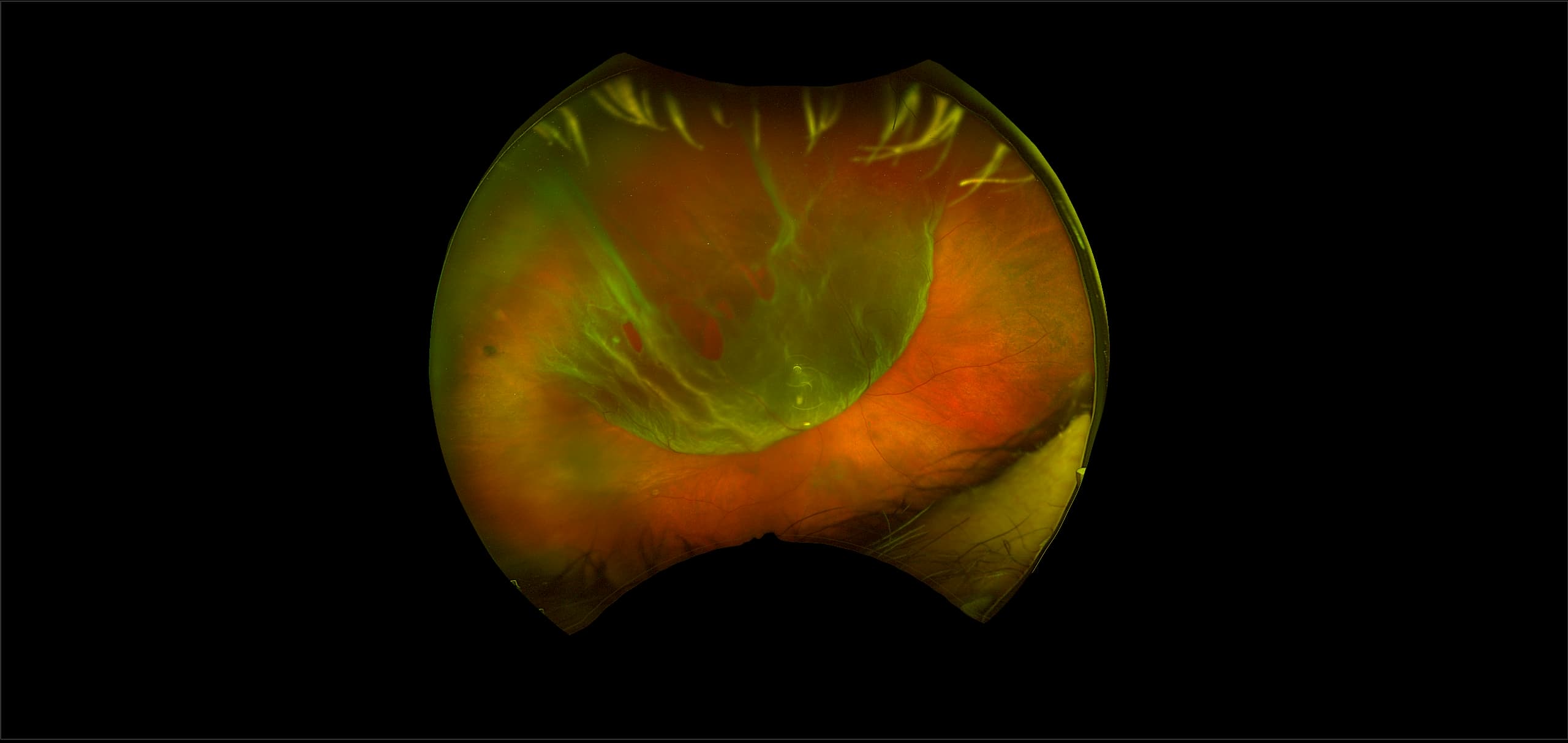 California - Retinal Break and Retinal Detachment, RG