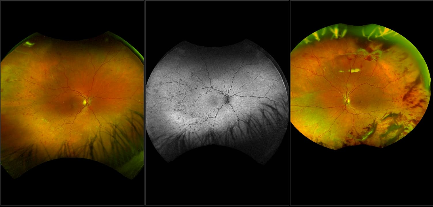 California - Prolific Diabetic Retinopathy, RG, AF