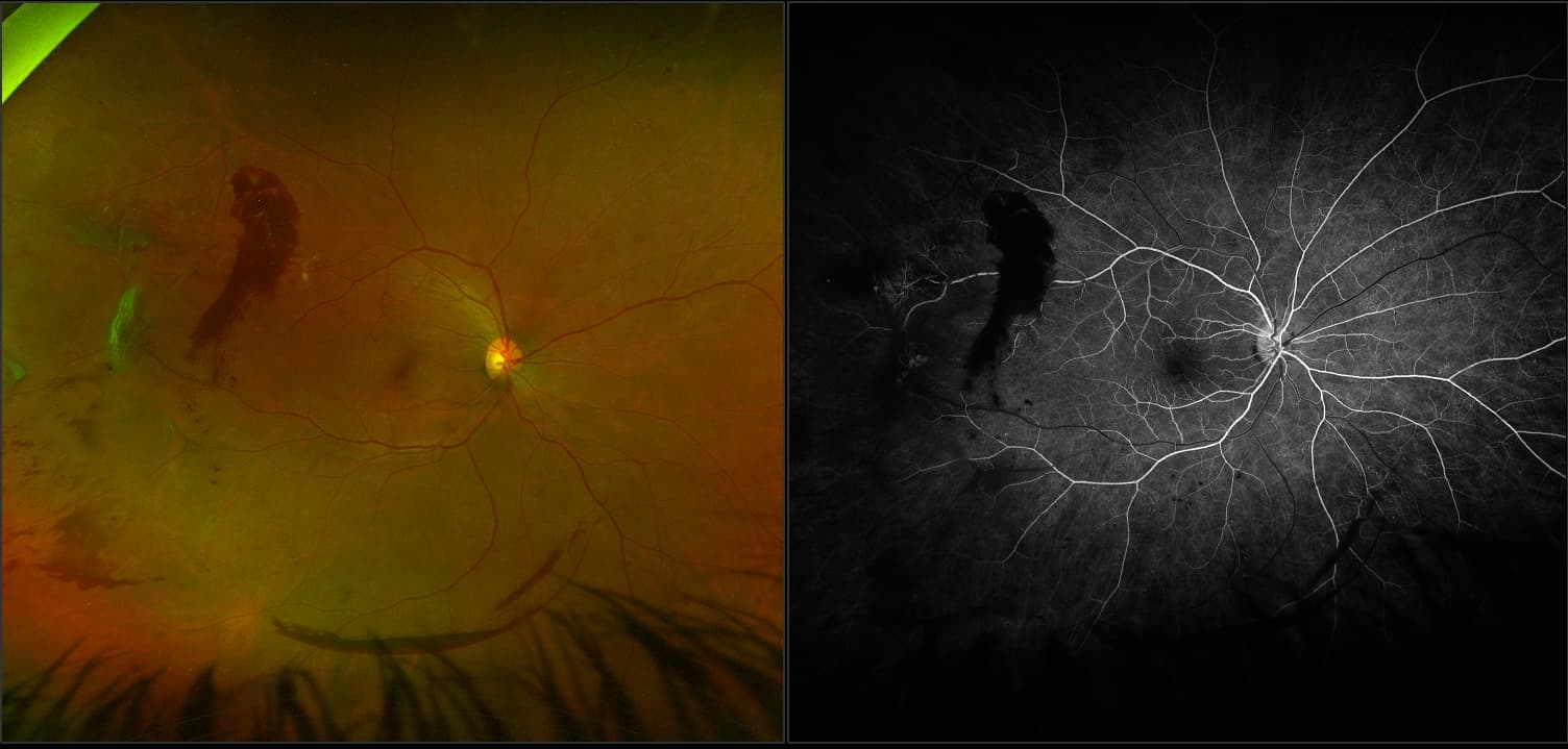 California - Prolific Diabetic Retinopathy with Retinal Detachment and PNP, RG, FA