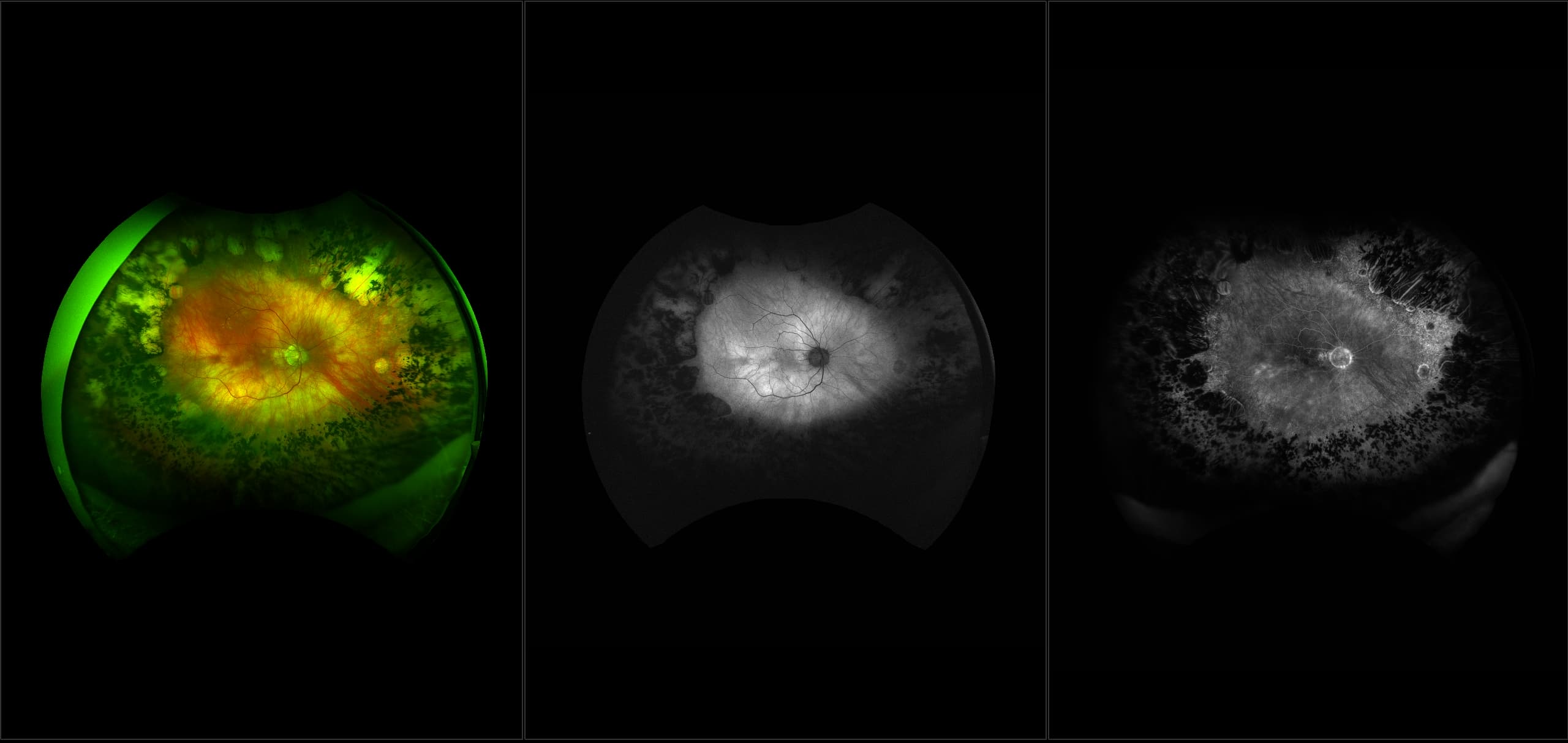 California - Retinitis Pigmentosa, RG, AF, FA