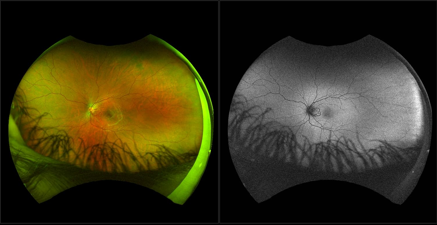 California - Arteriovenous Malformation, RG, AF